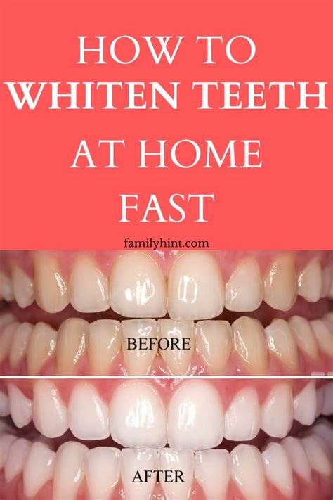 Teeth White