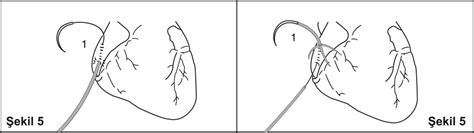 Temporary Wire Removal