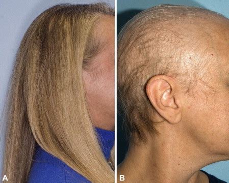 Temporary hair loss chemotherapy
