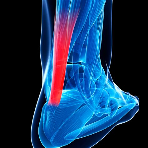 tendon rupture The Foot and Ankle Online Journal