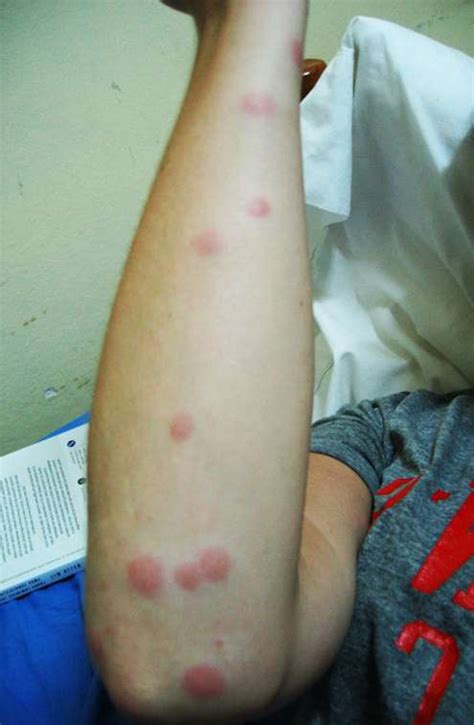 Beware of the Termites: Discover How Termite Bites on Skin can Cause Harmful Reactions