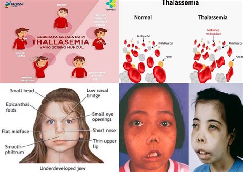 Thalassemia And Pregnancy The Classification Of Thalassemia