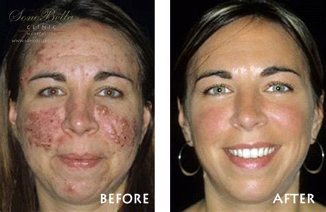 Acne Laser Before & After