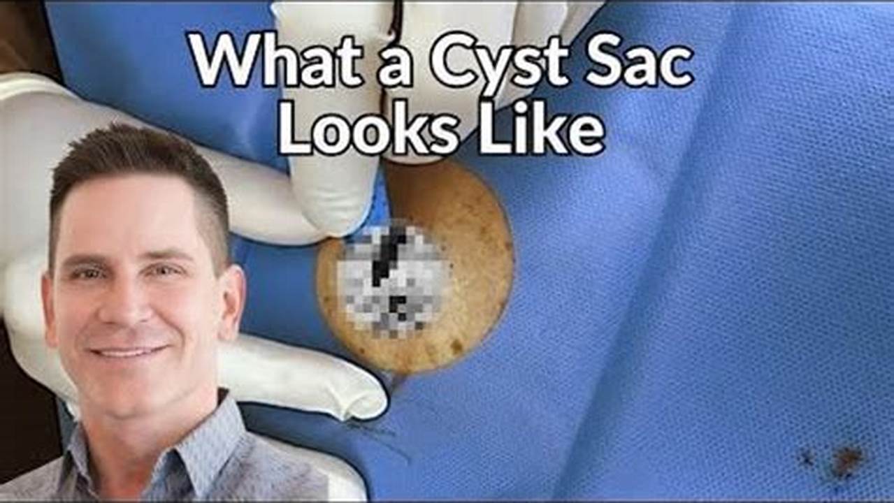 The Cyst Has A Particularly Large And Intact Sac., 2024