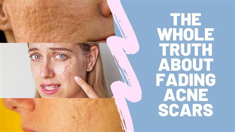 The Whole Truth about Fading Acne Scars YouTube