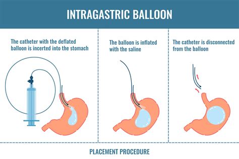 The Average Cost of the Gastric Balloon Procedure Without Insurance
