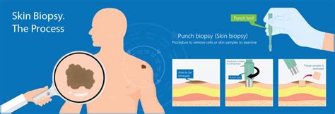 The Biopsy Process Explained