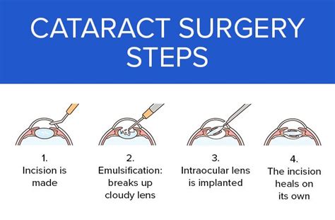 The Cataract Surgery Procedure (A Step-by-Step Look)