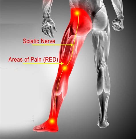 The Connection: Sciatica and Hip Pain