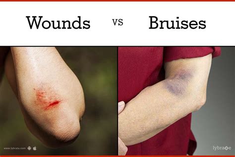 The Difference Between Bruises and Capillary Damage