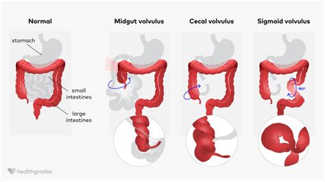 The Difference Between Dilation and Volvulus