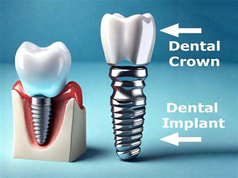 The Difference Between Implants and Crowns
