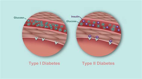 The Difference Between Type 1 and Type 2 Diabetes