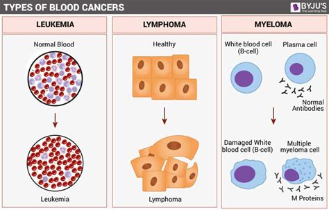 The Different Types of Blood Cancer Explained
