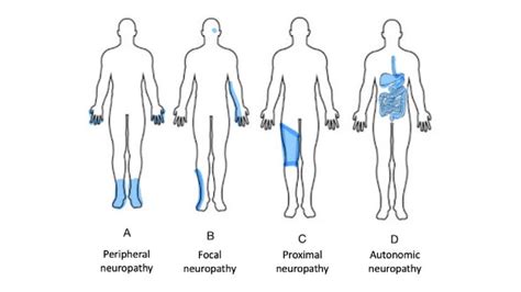 The Different Types of Diabetic Neuropathy