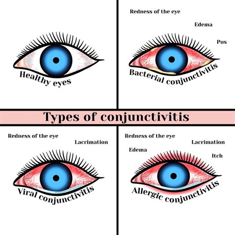 The Dreaded Red Eye and Conjunctivitis