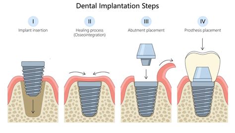 The Implant Process: What to Expect