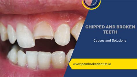 The Importance of Fixing Chipped Teeth