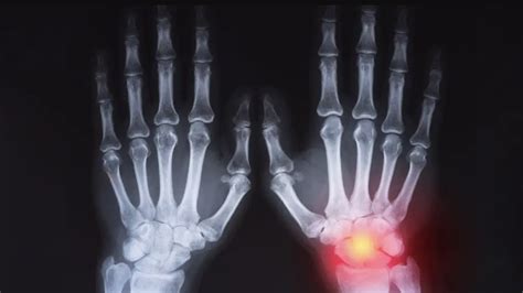 The Limitations of X-Rays