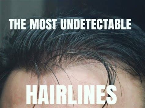 The Magic of Undetectable Hairlines