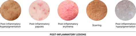 The Main Culprit: Post-Inflammatory Changes