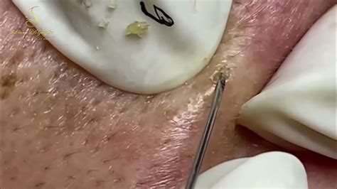 The Most Disgusting Pimple Extraction You'll Ever Witness
