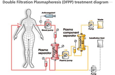 The Plasmapheresis Procedure