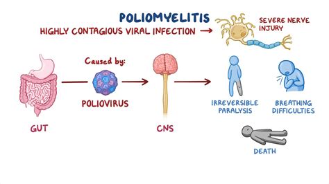 The Poliovirus: The Main Culprit