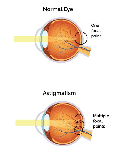 The Role of Astigmatism