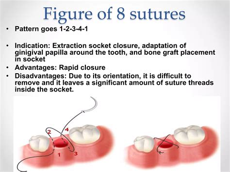 The Role of Sutures in Tooth Extraction