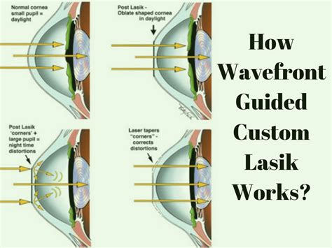 The Technology Factor: Standard vs. Custom LASIK
