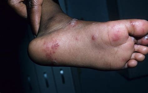 The Tell-Tale Signs of a Foot Shingles Rash