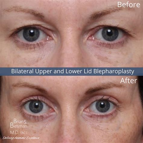 The Two Main Types of Lower Blepharoplasty