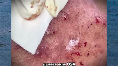 The Ultimate Pimple Fail Exploding Zit Leaves Face Disfigured