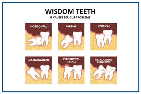 The Wisdom Tooth Removal Procedure A Quick Overview