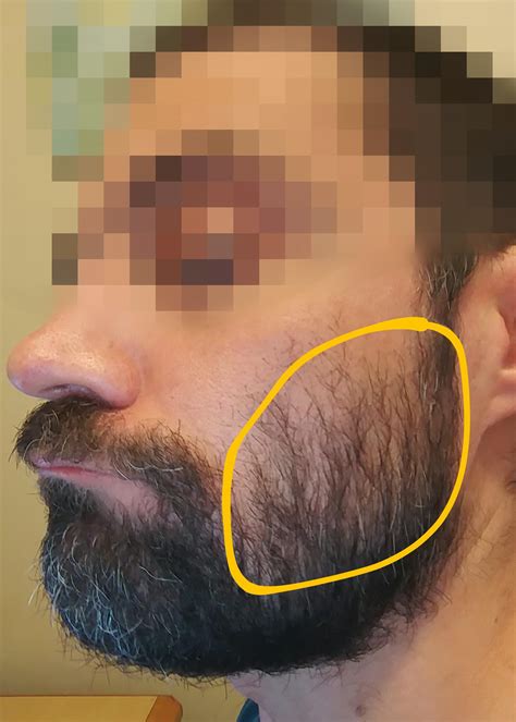 Thin Beard On Cheeks