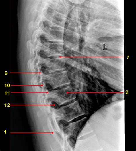 Spine Ray Anatomy