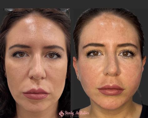 Thread Lift: Lift & Sculpt Your Face.