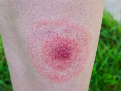 Disease Rash