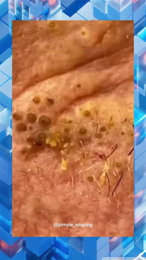 TikTok Sensation Exploding Pimple Video Goes Viral