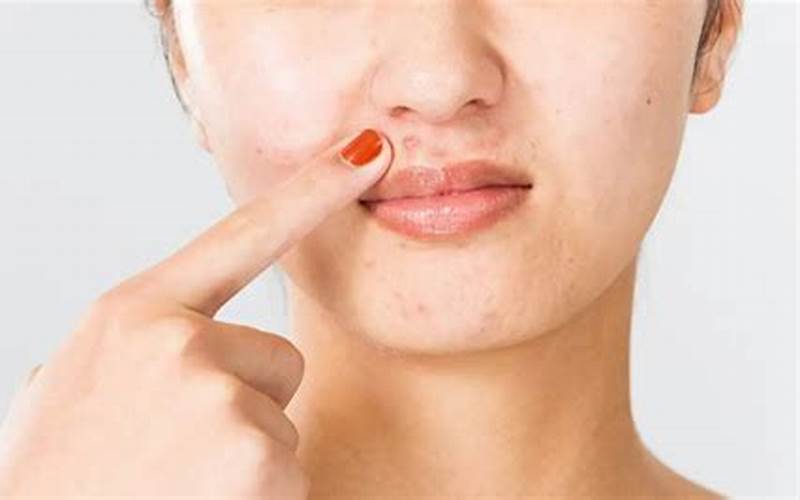 Tips Dan Cara Mudah Menghilangkan Jerawat Diatas Bibir
