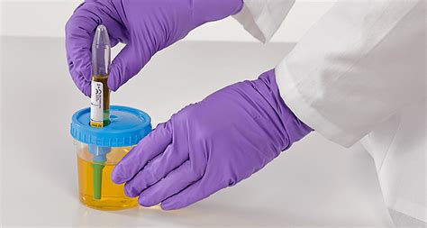 Tips For Collecting Urine Culture Samples From Nephrostomy Tubes
