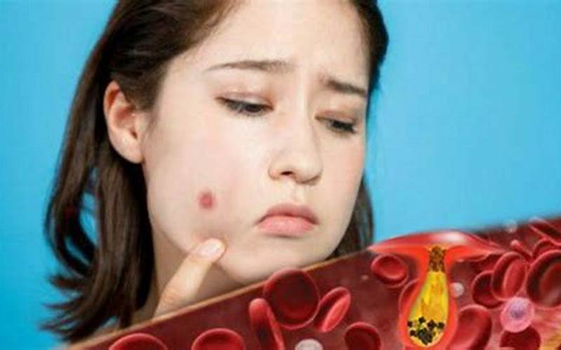 Tips Membersihkan Darah Kotor Penyebab Jerawat