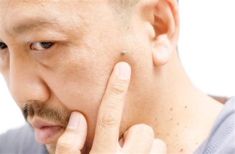 Tips Dan Cara Bagaimana Menghilangkan Daging Tumbuh Di Bawah Mata