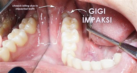 Tips Dan Cara Bagaimana Menghilangkan Rasa Sakit Gigi Gusi Bengkak