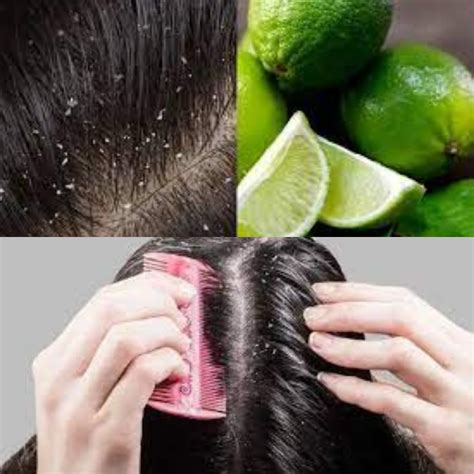 Tips Menghindari Ketombe