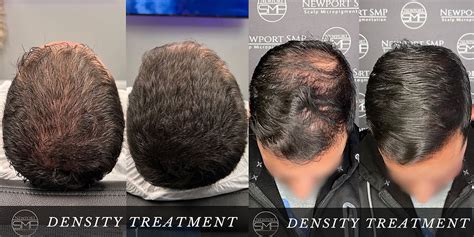 Tips for Matching Hairline and Density