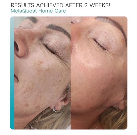 Tips for Maximizing Results with Your Serum For Hyperpigmentation