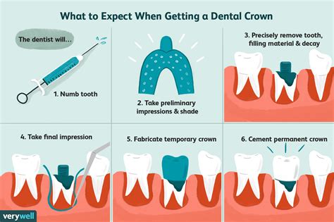 Tips for Saving Money on Dental Crowns