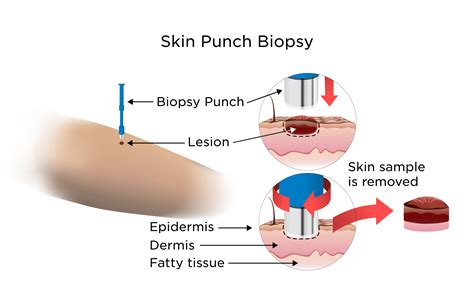 Tissue Biopsy